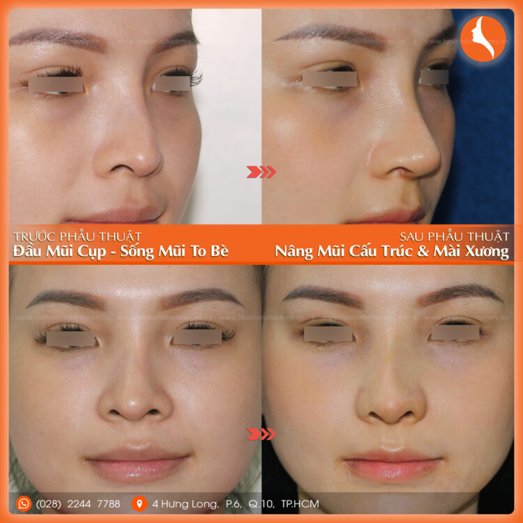 nâng mũi cấu trúc là gì