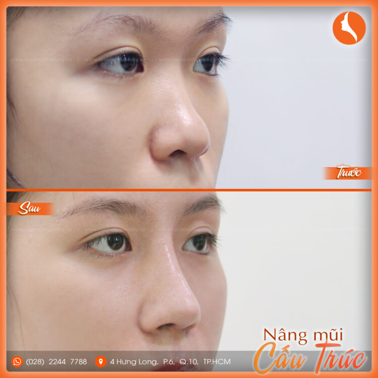 nâng mũi cấu trúc