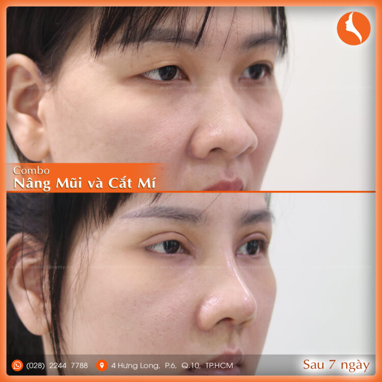 nâng mũi cấu trúc