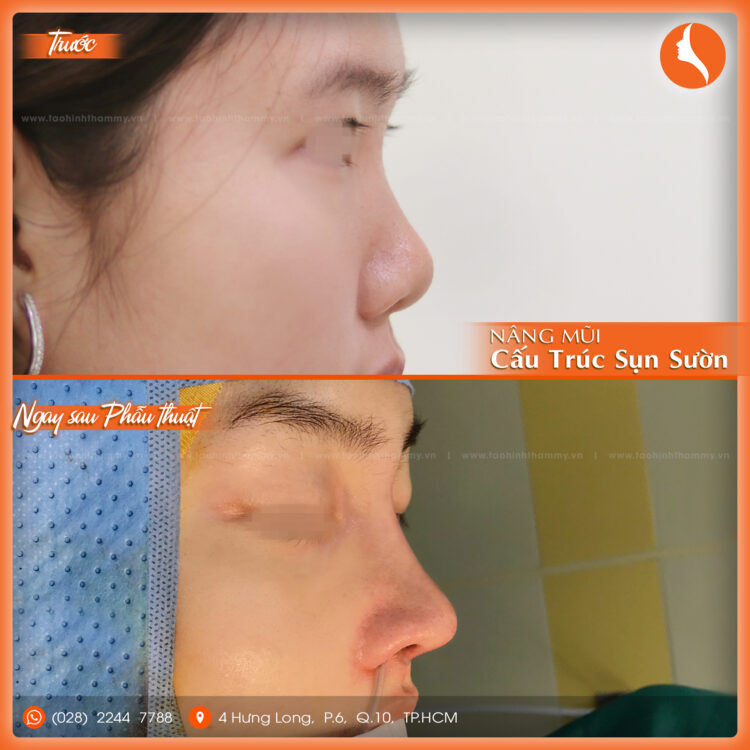 nâng mũi cấu trúc