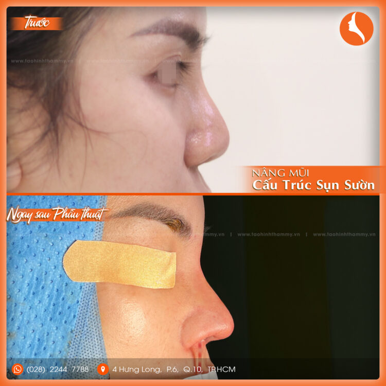 nâng mũi cấu trúc