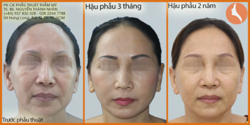 Căng da mặt bs Nhân