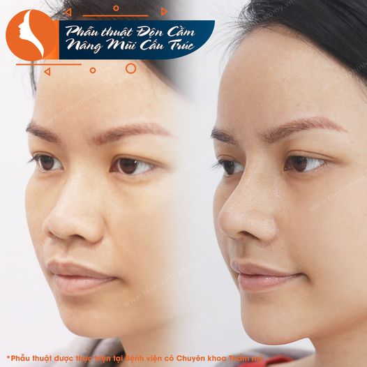 Phẫu thuật Độn Cằm