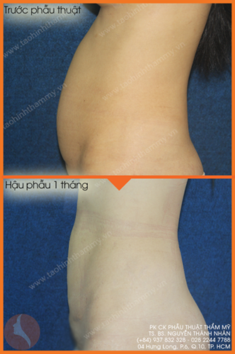 hút mỡ bụng đẹp
