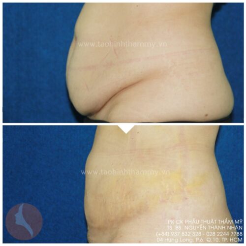 hút mỡ bụng uy tín