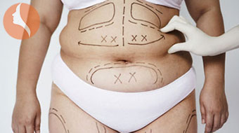 Hút mõ bụng bác sĩ nhân