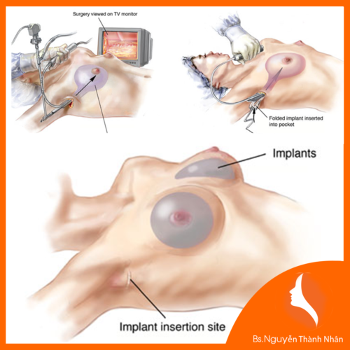 Hình ảnh mô phỏng kỹ thuật nâng ngực nội soi